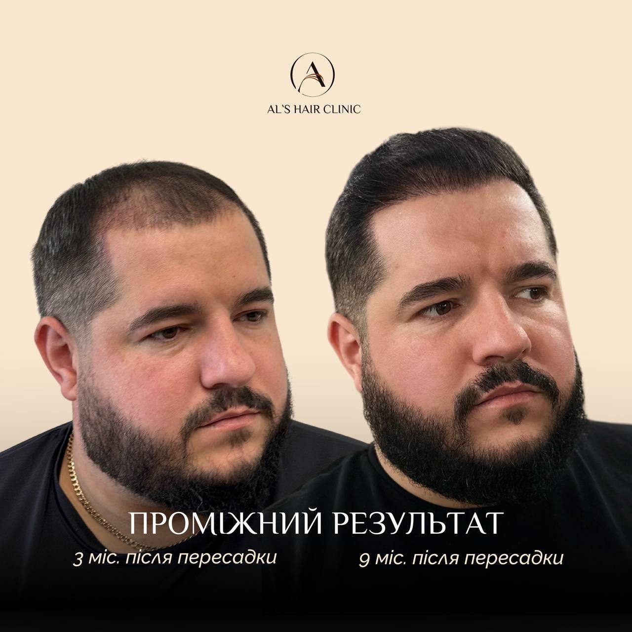 Після - Пересадка волосся